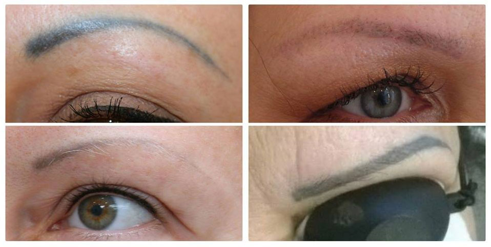 Laserowe usuwanie makijażu permanentnego brwi. Przed i po efekty